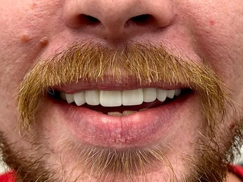 After: Smile transformation 18