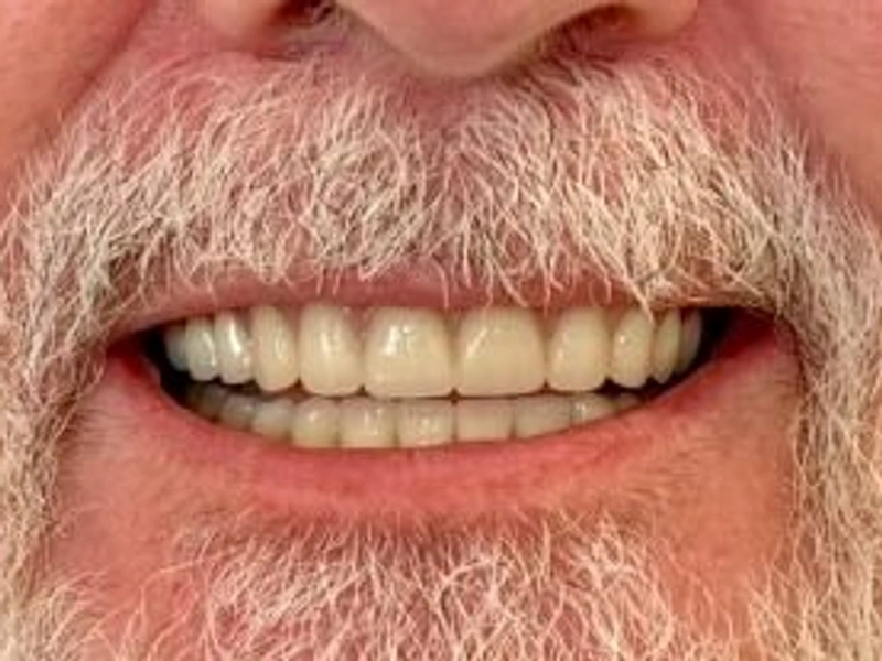 After: Smile transformation 19