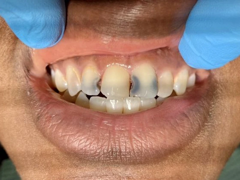 Before: Smile transformation 11