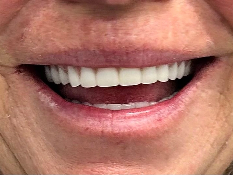 After: Smile transformation 20