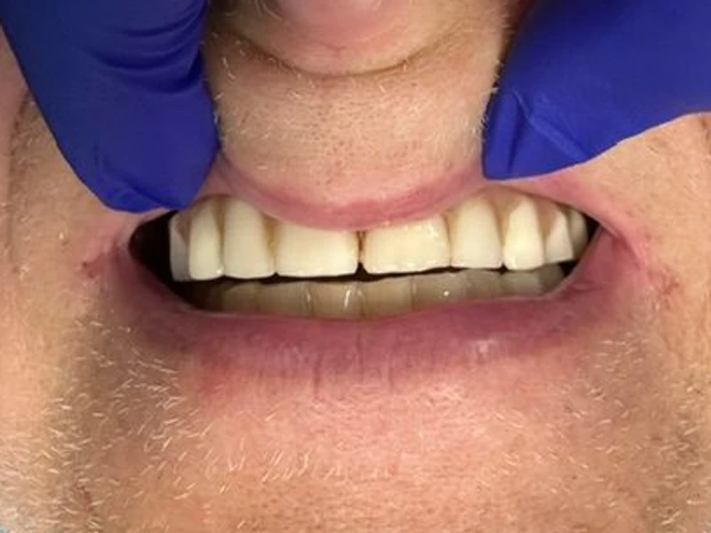 Before: Smile transformation 21
