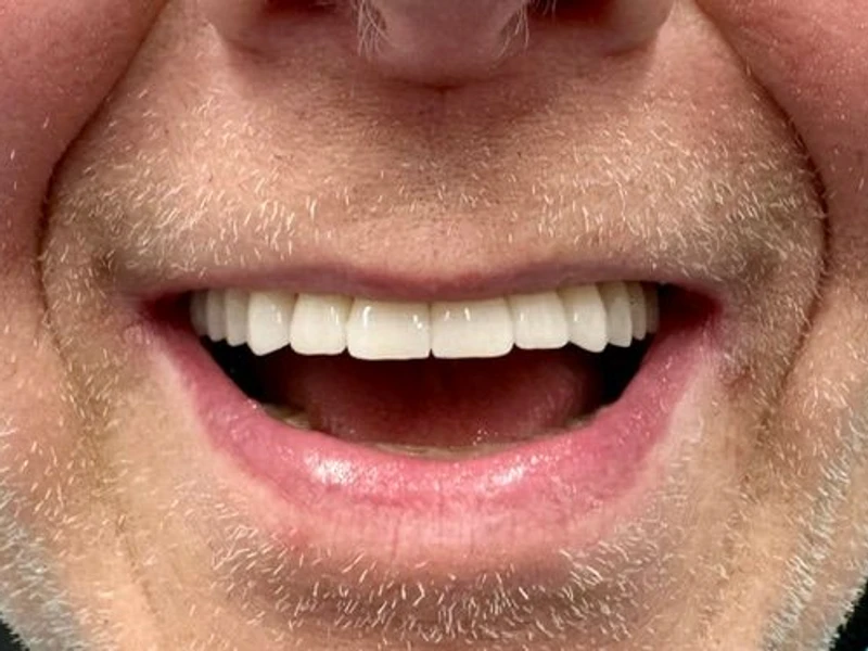 After: Smile transformation 21