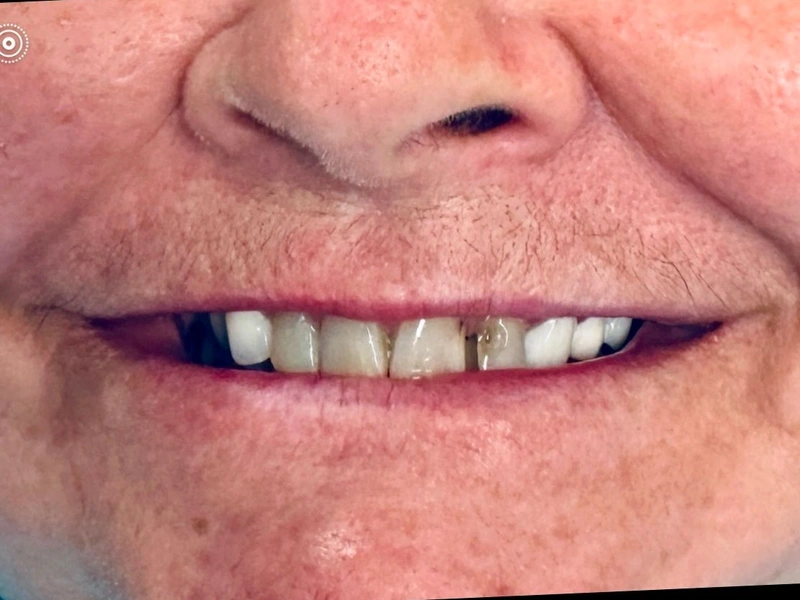 Before: Smile transformation 22