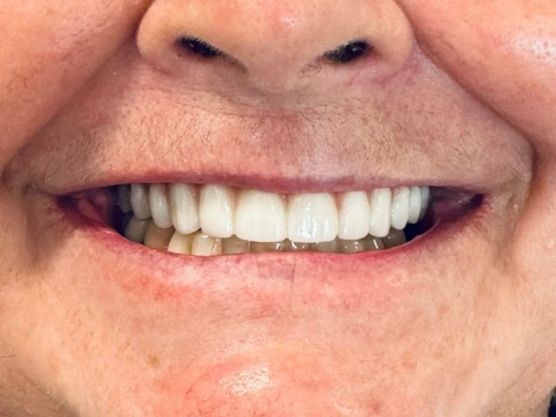 After: Smile transformation 22