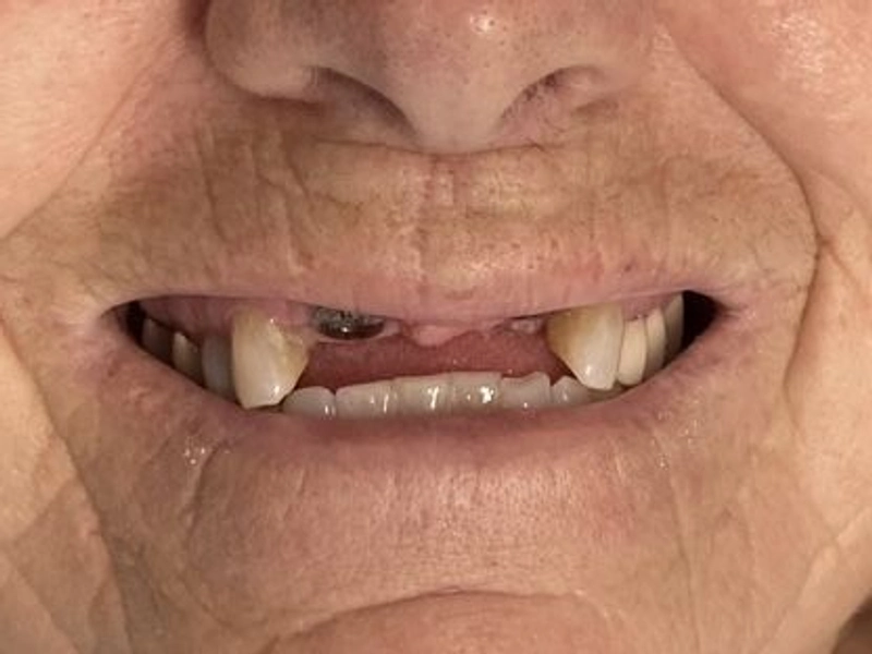 Before: Smile transformation 23