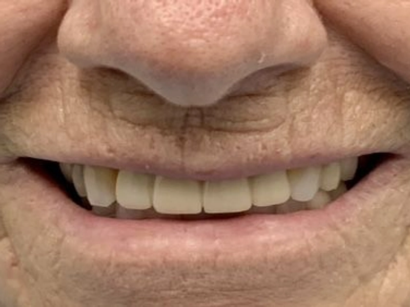 After: Smile transformation 23