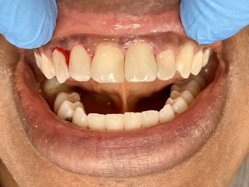 After: Smile transformation 11