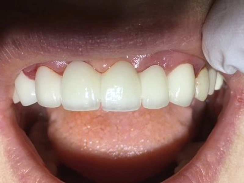After: Smile transformation 24