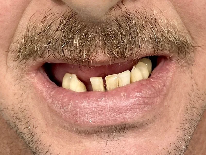 Before: Smile transformation 26
