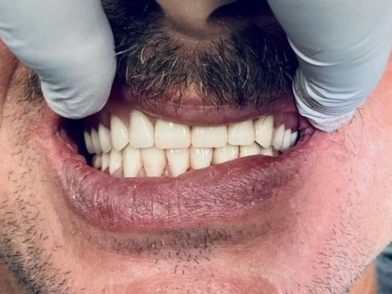 After: Smile transformation 26