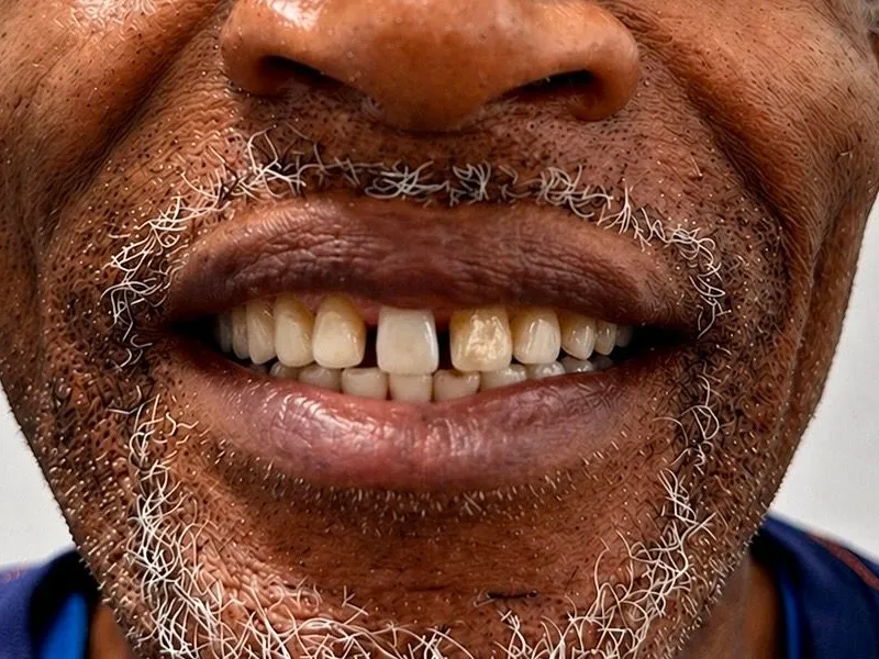 Before: Smile transformation 27