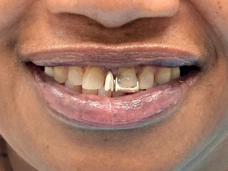 Before: Smile transformation 12