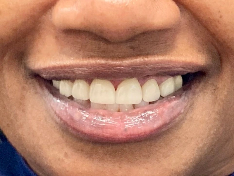 After: Smile transformation 12