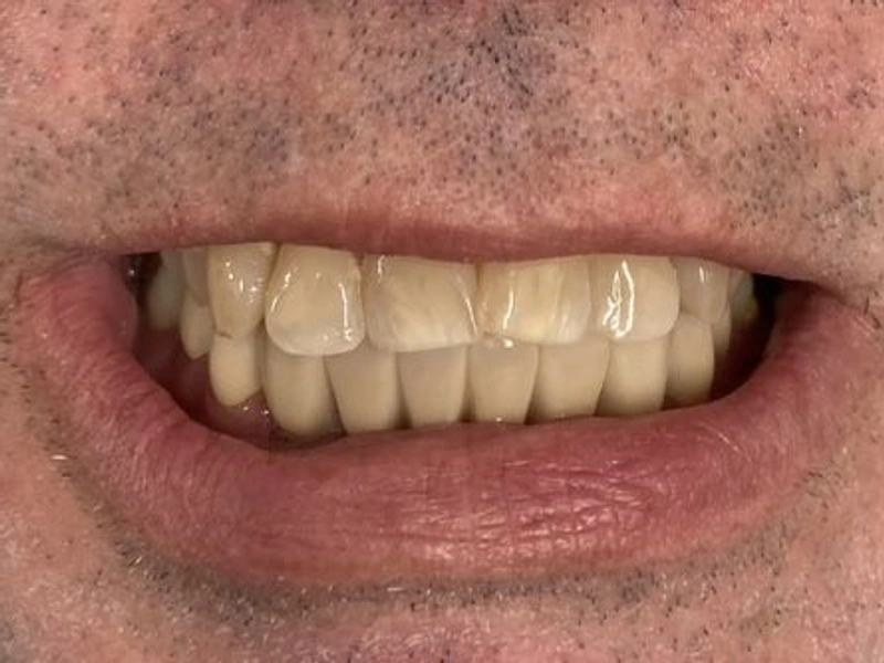 After: Smile transformation 13