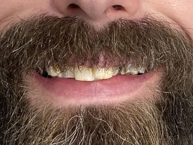 Before: Smile transformation 14