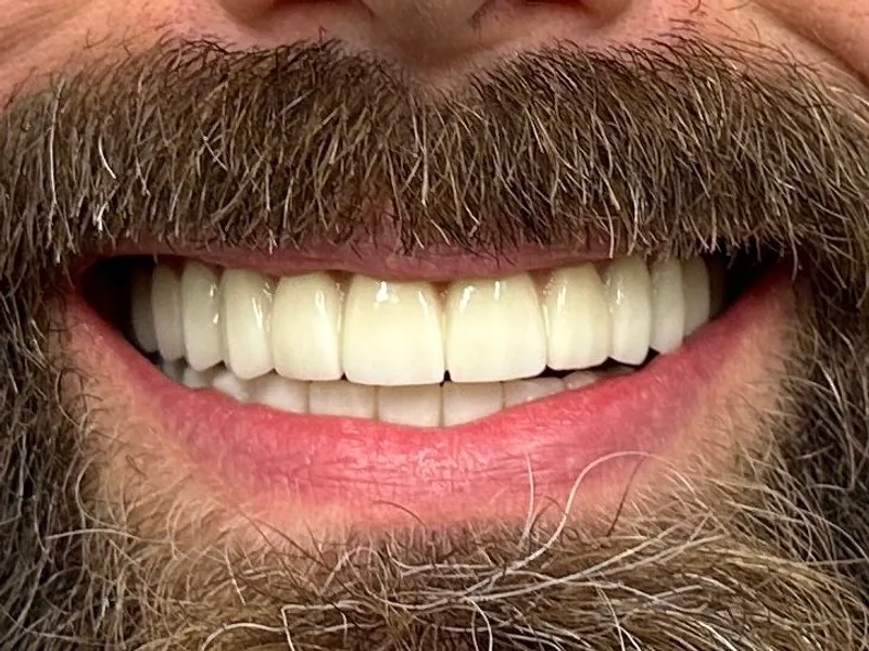 After: Smile transformation 14